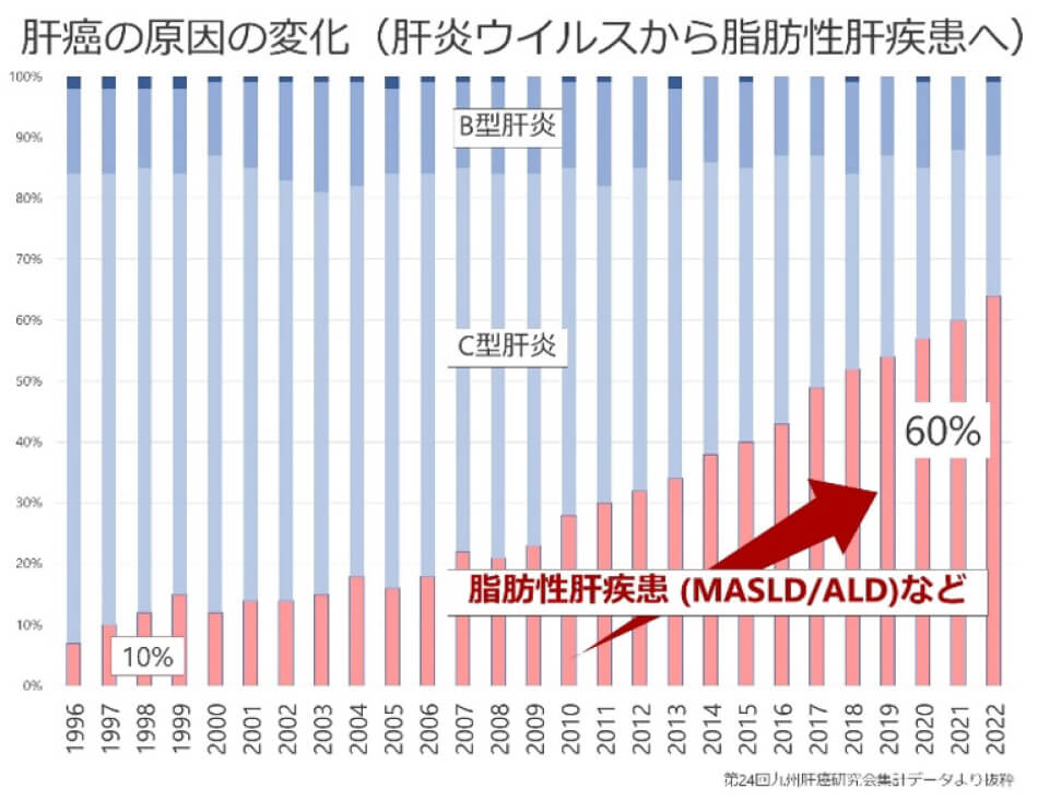 肝癌の原因の変化（肝炎ウイルスから脂肪性肝疾患へ）